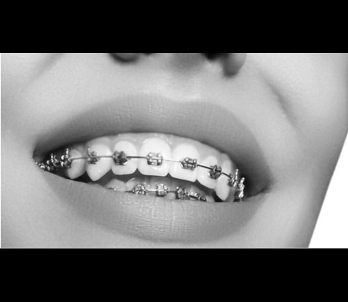 Orthodontics – Braces and Clear Aligners