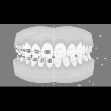 How do I prevent white spots on my teeth?