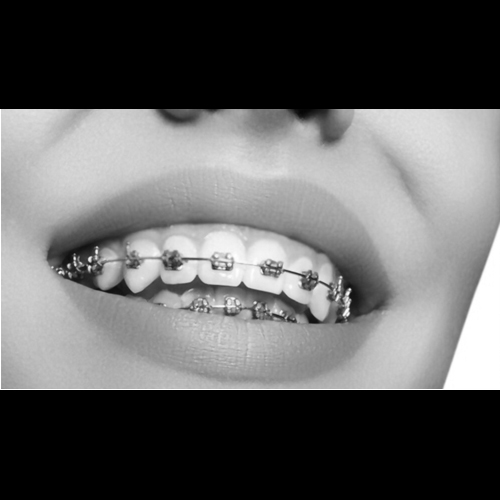 Orthodontics – Braces and Clear Aligners