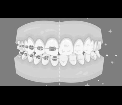 How do I prevent white spots on my teeth?