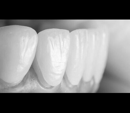 How Much Does A Hollywood Smile, Veneers, Cost?