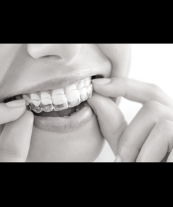 Is Invisalign Right for you?