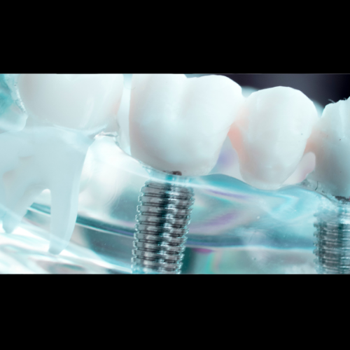 What are the Lifetime Benefits of Dental Implants in Abu Dhabi