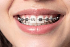 Child orthodontic assessment at Al Bahri Dental & Orthodontic Center