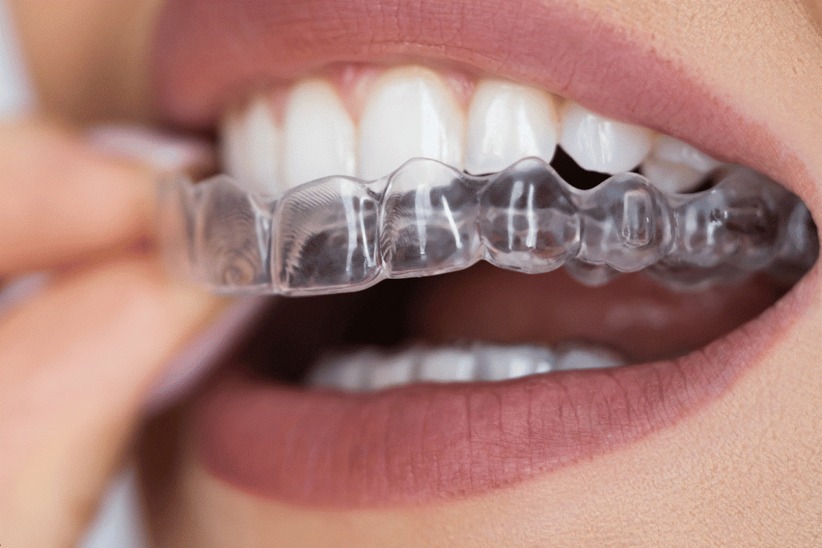 Clear-aligners-in-Abu-Dhabi-for-gap-teeth-correction.png