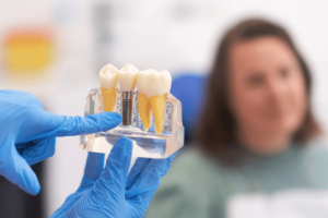 Dental Implant Longevity: How Long Do They Last? | Al Bahri Dental