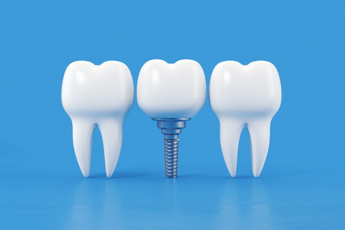 Dental-Implants-Abu-Dhabi-│-Al-Bahri-Dental1.png