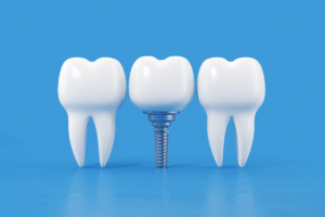 Dental Implants Abu Dhabi │ Al-Bahri Dental