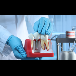 Dental Implants in Al Ain