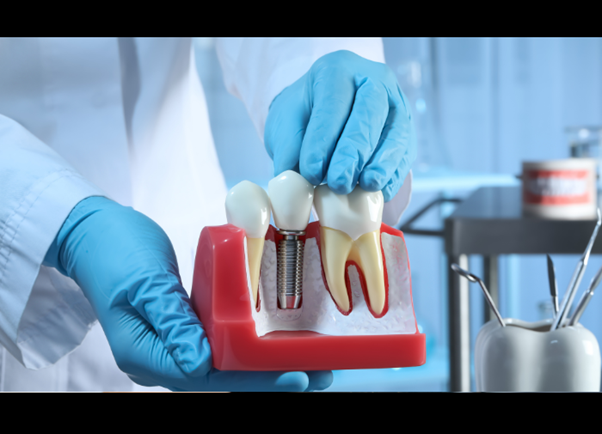Understanding the Dental Implant Process: Step-by-Step Guide