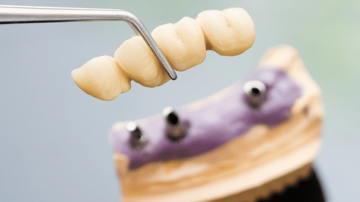 Is a Dental Bridge the Right Treatment for You?