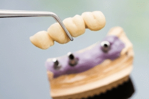 Dental bridge treatment before and after in Abu Dhabi