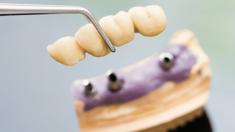 Is a Dental Bridge the Right Treatment for You?