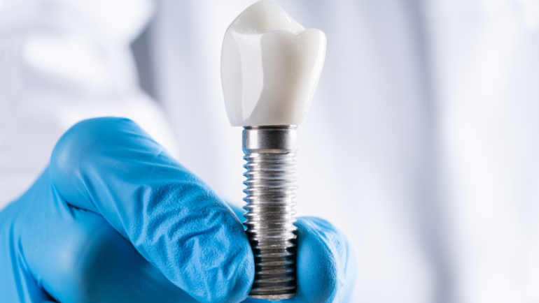Can You Get a Dental Implant After Losing a Tooth Years Ago?