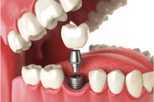 Dental implants in Abu Dhabi | dental implants Specialist | Al Bahri Dental