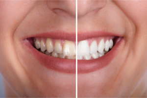 Dental restorations before and after teeth whitening