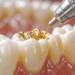 Are There Different Types of Dental Fillings? A Complete Guide