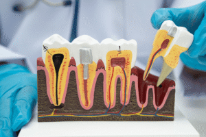 Dentist explaining post root canal care and dental crown treatment at Al Bahri Dental Abu Dhabi