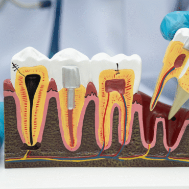 How to Protect Your Tooth After a Root Canal