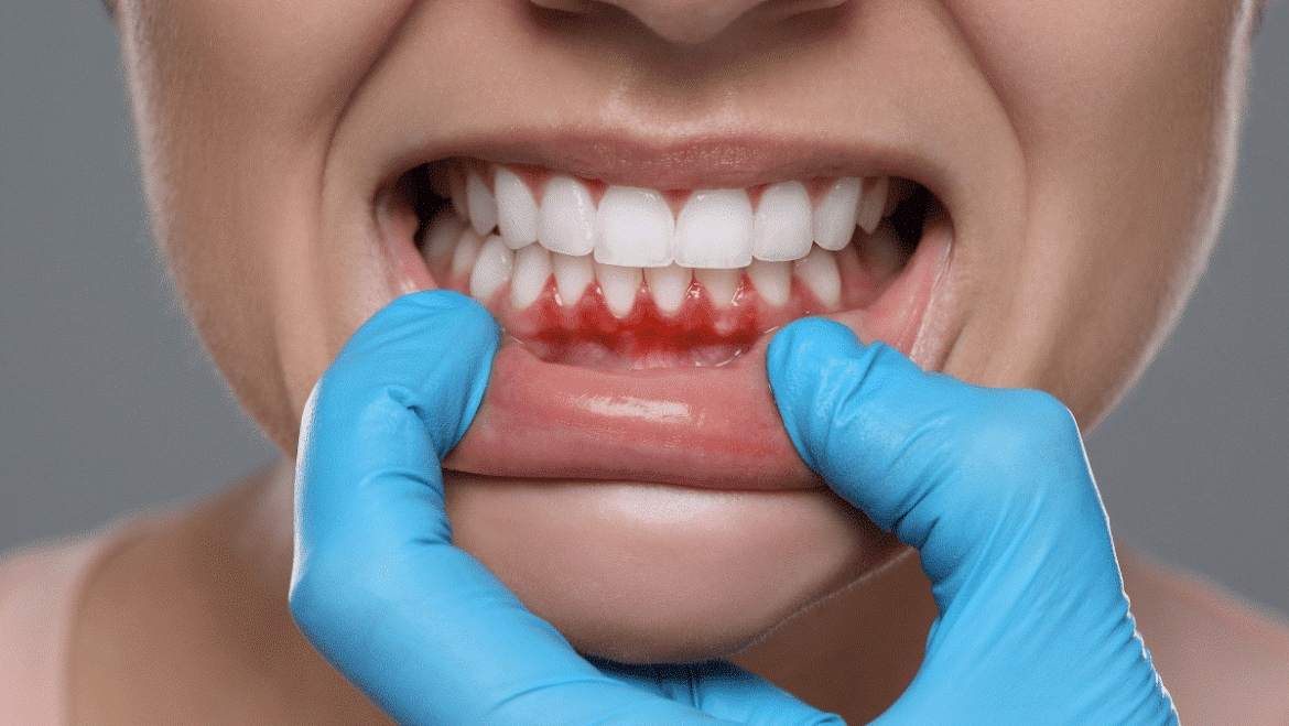 Best Treatments for Gum Disease: What to Expect at the Dentist
