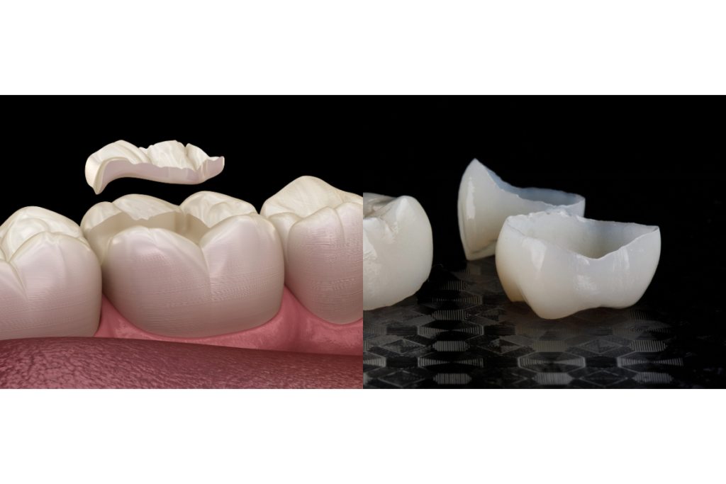 Onlay vs crown dental restoration comparison