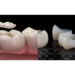 Onlay vs Crown: What’s the Difference?