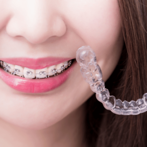 Orthodontist service Al Ain | Braces treatment | Al Bahri Dental and Orthodontic Center