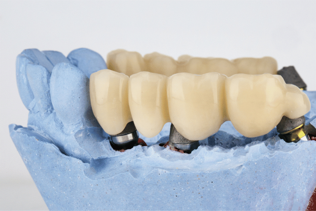 Patient smile restoration with dental bridge in Abu Dhabi