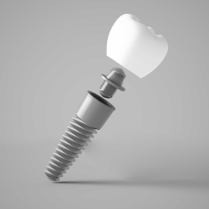 Prosthodontics Services Abu Dhabi | Al Bahri Dental and Orthodontic Center