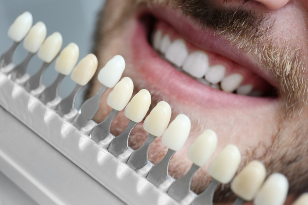 Teeth whitening with crowns veneers and fillings