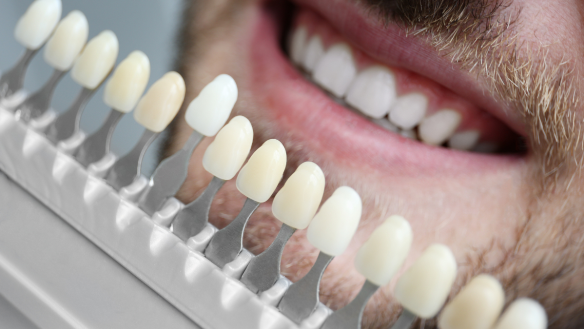Can You Whiten Crowns, Veneers, or Fillings?
