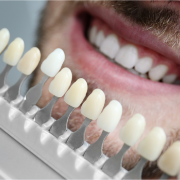 Can You Whiten Crowns, Veneers, or Fillings?