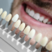 Can You Whiten Crowns, Veneers, or Fillings?