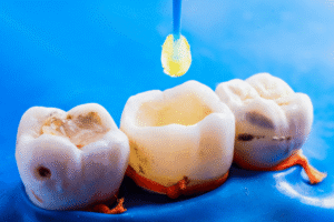Tooth restoration with composite resin filling performed by a dentist in Abu Dhabi