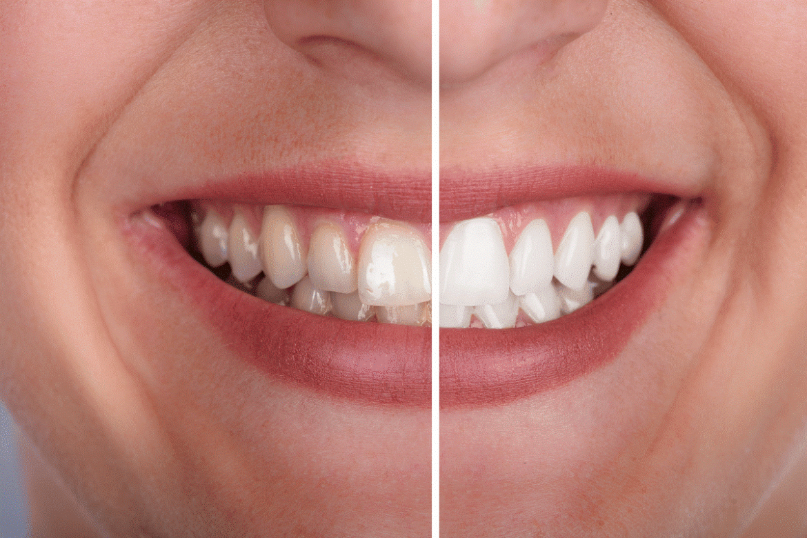 Understanding-Your-Whitening-Results.png