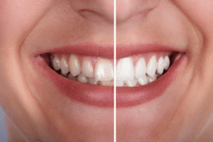 Understanding Your Whitening Results