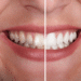 How to Make Your Teeth Whitening Results Last Longer