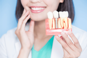 best dental implants in Abu Dhabi
